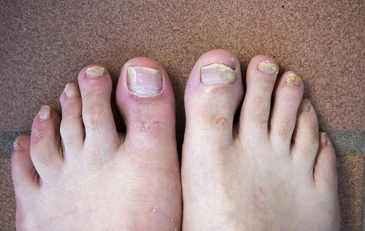 Natural Remedies for Nail Fungi: What Works and What Doesn’t