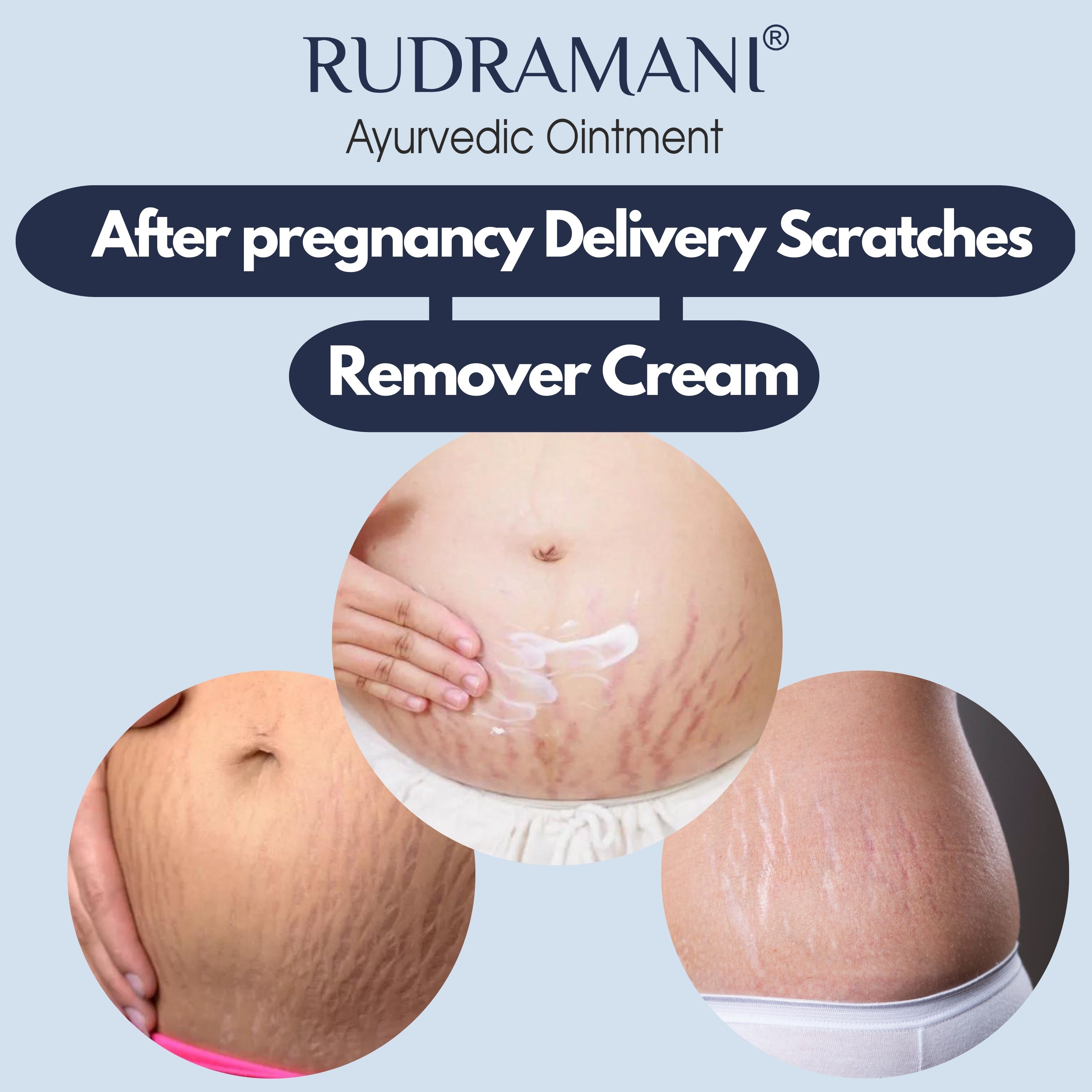 Rudramani Ayurvedic Malam (Cream) for Anti-Fungal Infection, Itching & Skin Recovery for All Skin Types 25gm